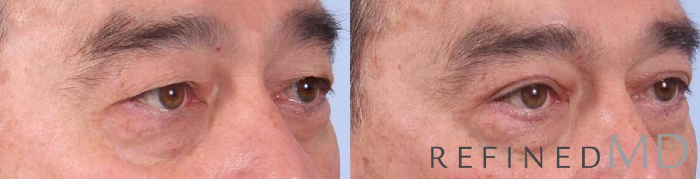 Before & After Upper Eyelid Case 1109 View 2 View in Los Gatos & San Jose, CA