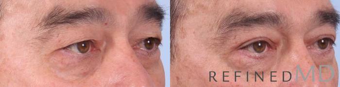 Before & After Upper Eyelid Case 1109 View 2 View in Los Gatos & San Jose, CA