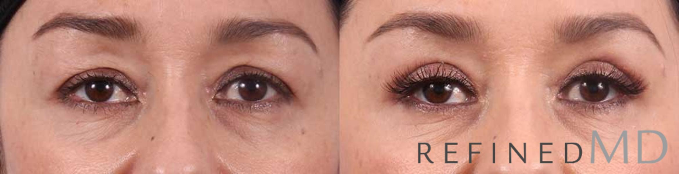 Before & After Upper Eyelid Case 1110 View 1 View in Los Gatos & San Jose, CA