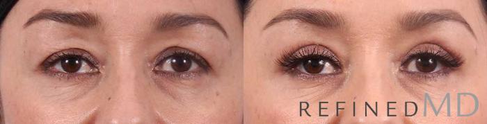 Before & After Upper Eyelid Case 1110 View 1 View in Los Gatos & San Jose, CA