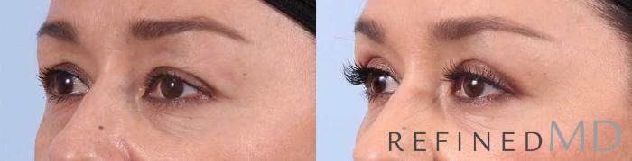 Before & After Upper Eyelid Case 1110 View 2 View in Los Gatos & San Jose, CA