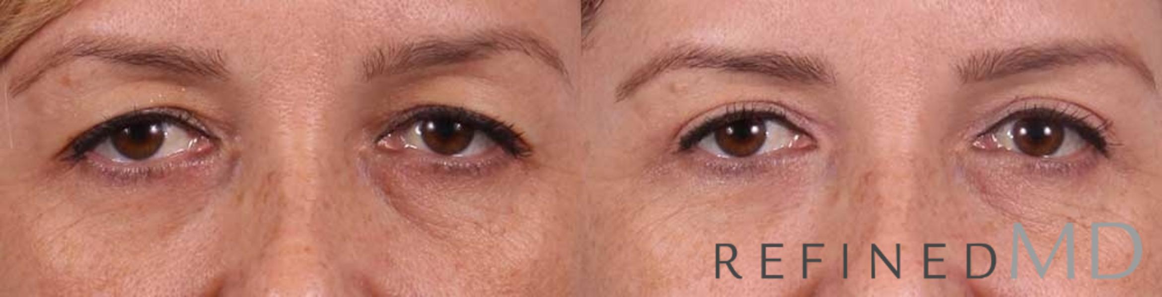 Before & After Upper Eyelid Case 1111 View 1 View in Los Gatos & San Jose, CA
