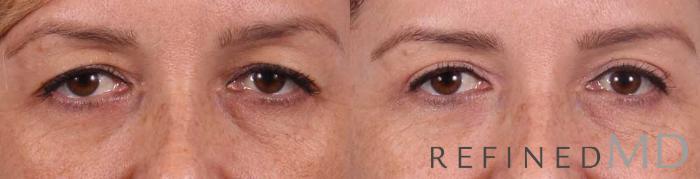 Before & After Upper Eyelid Case 1111 View 1 View in Los Gatos & San Jose, CA