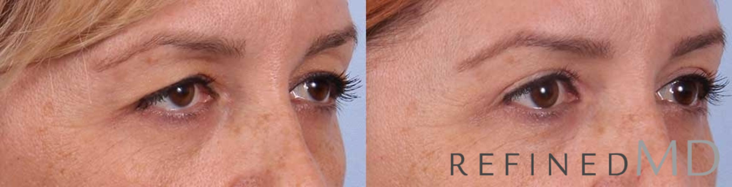 Before & After Upper Eyelid Case 1111 View 2 View in Los Gatos & San Jose, CA