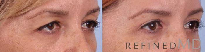 Before & After Upper Eyelid Case 1111 View 2 View in Los Gatos & San Jose, CA