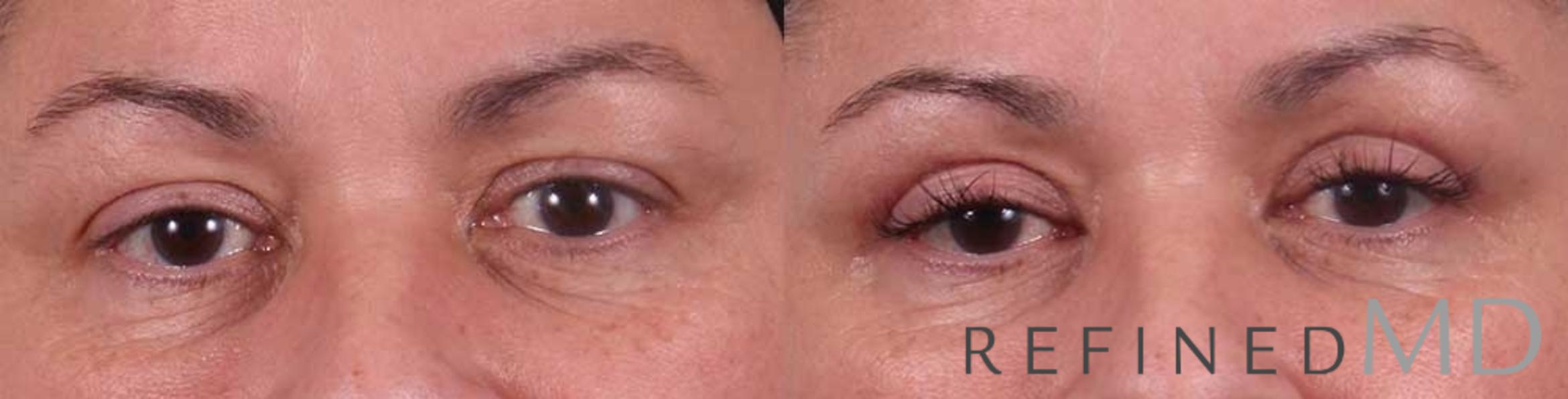 Before & After Upper Eyelid Case 1112 View 1 View in Los Gatos & San Jose, CA