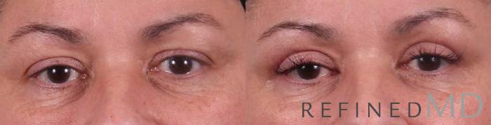 Before & After Upper Eyelid Case 1112 View 1 View in Los Gatos & San Jose, CA