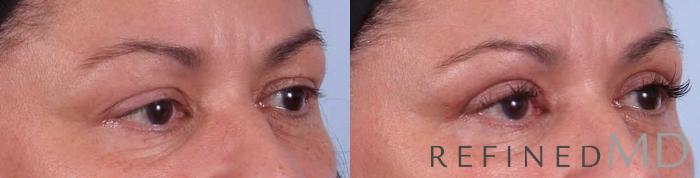 Before & After Upper Eyelid Case 1112 View 2 View in Los Gatos & San Jose, CA