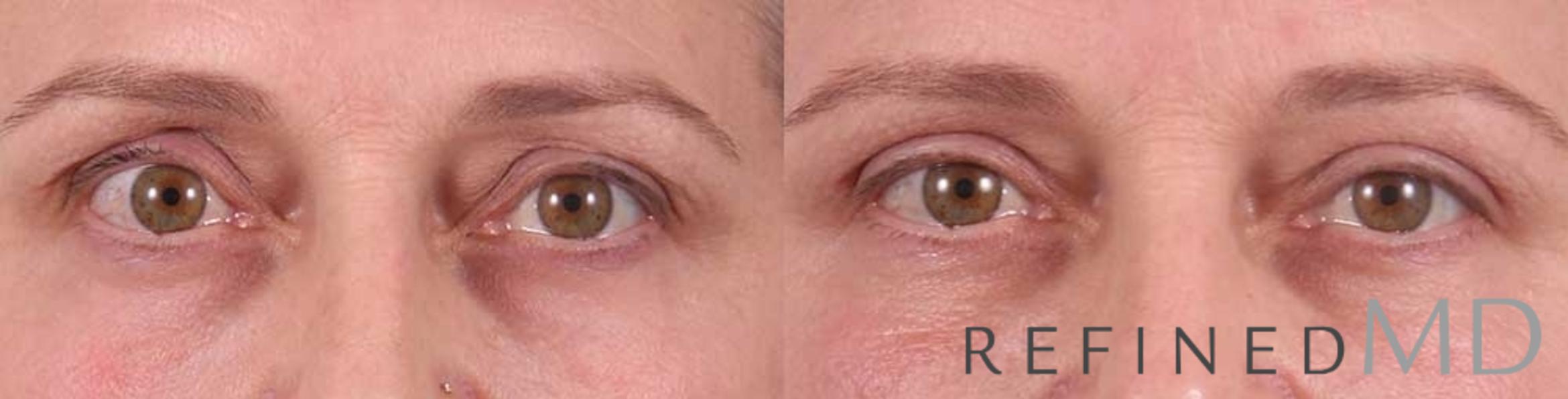 Before & After Upper Eyelid Case 1113 View 1 View in Los Gatos & San Jose, CA