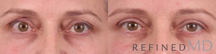 Before & After Upper Eyelid Case 1113 View 1 View in Los Gatos & San Jose, CA