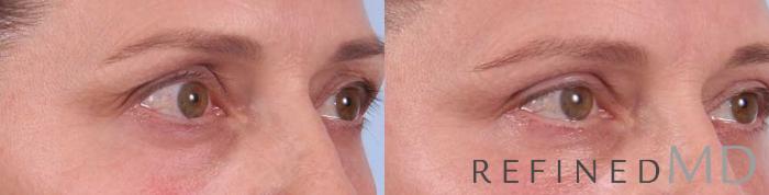 Before & After Upper Eyelid Case 1113 View 2 View in Los Gatos & San Jose, CA