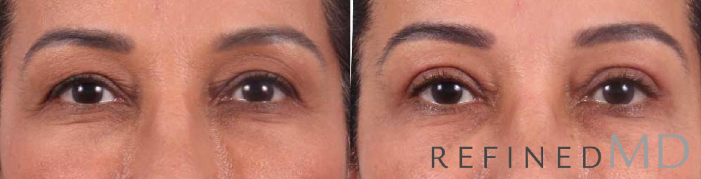 Before & After Upper Eyelid Case 1114 View 1 View in Los Gatos & San Jose, CA