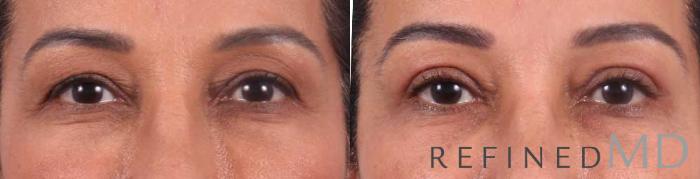 Before & After Upper Eyelid Case 1114 View 1 View in Los Gatos & San Jose, CA