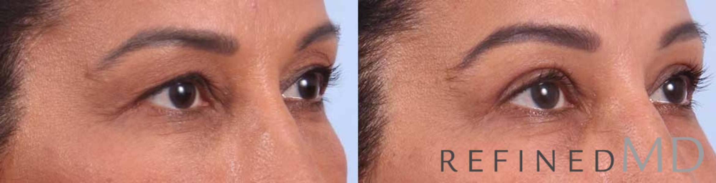 Before & After Upper Eyelid Case 1114 View 2 View in Los Gatos & San Jose, CA