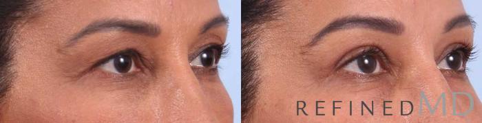 Before & After Upper Eyelid Case 1114 View 2 View in Los Gatos & San Jose, CA