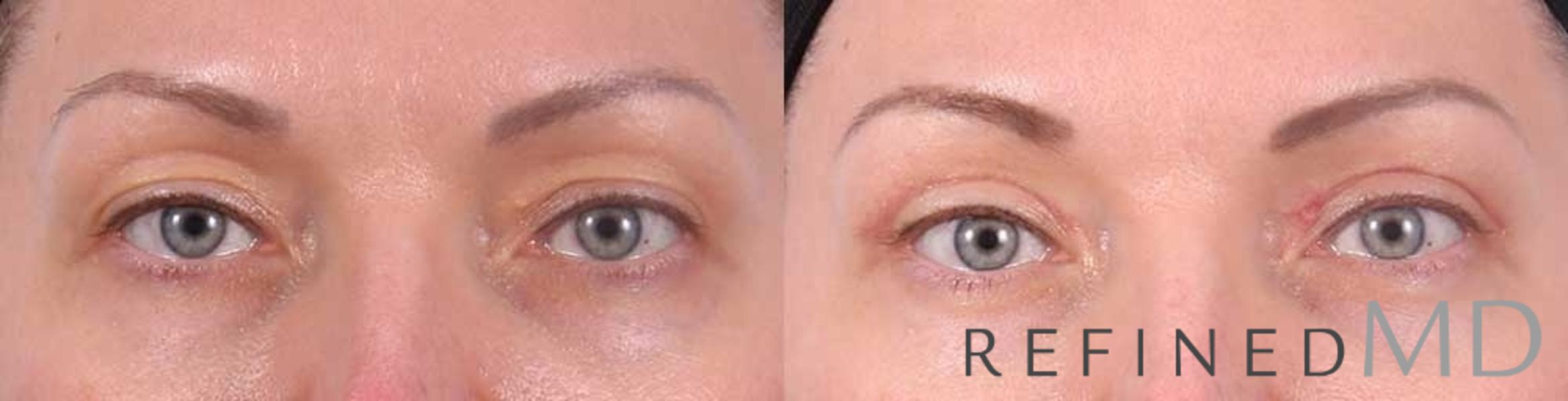 Before & After Upper Eyelid Case 1115 View 1 View in Los Gatos & San Jose, CA