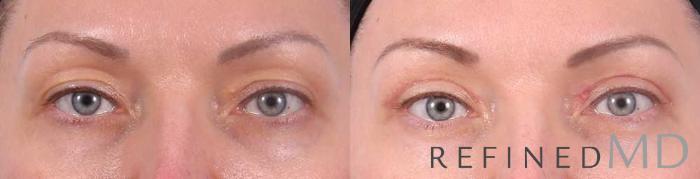Before & After Upper Eyelid Case 1115 View 1 View in Los Gatos & San Jose, CA