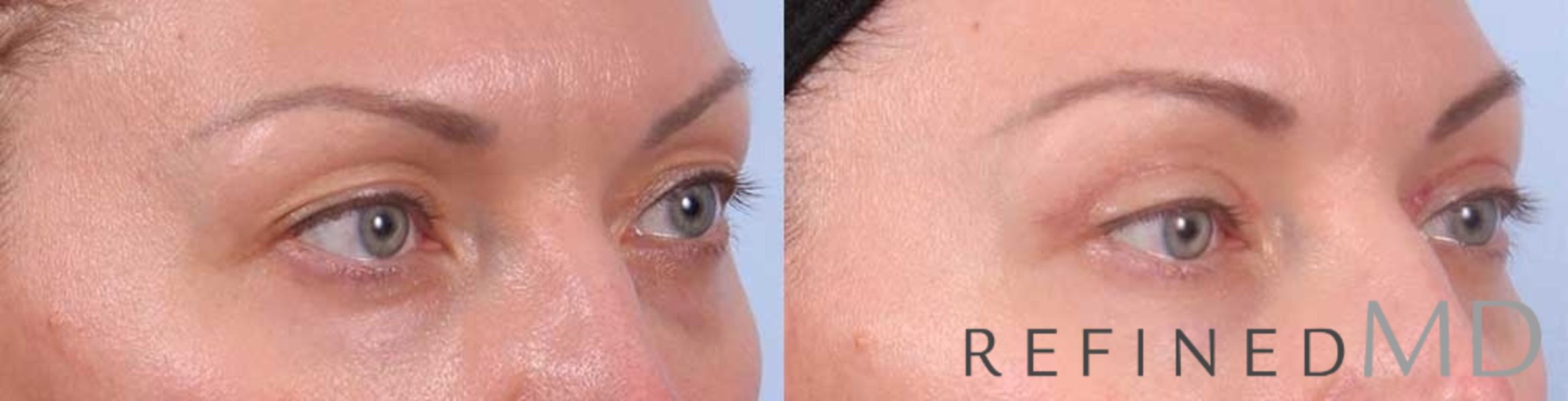 Before & After Upper Eyelid Case 1115 View 2 View in Los Gatos & San Jose, CA