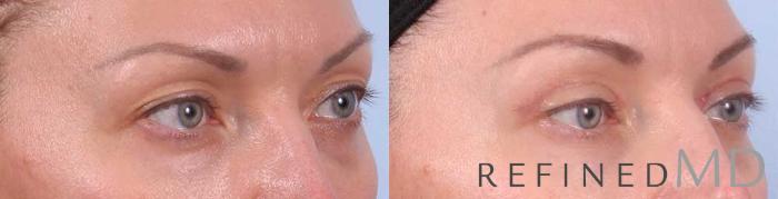 Before & After Upper Eyelid Case 1115 View 2 View in Los Gatos & San Jose, CA